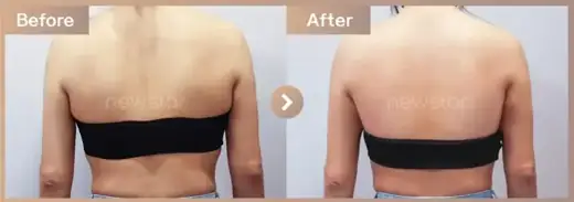 Fat-dissolving injections: before-and-after comparison at Newstar Clinic