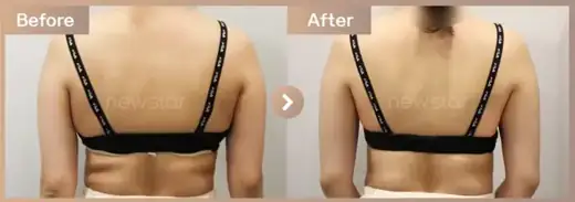 Fat-dissolving injections: before-and-after comparison at Newstar Clinic