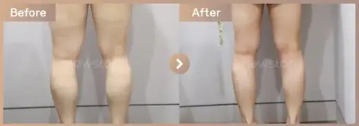 Fat-dissolving injections: before-and-after comparison at Newstar Clinic