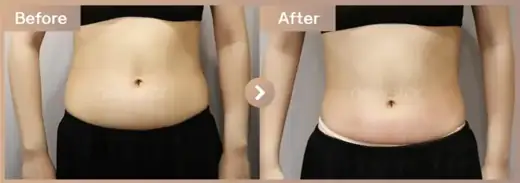Fat-dissolving injections: before-and-after comparison at Newstar Clinic