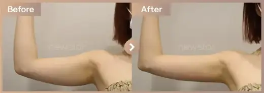 Fat-dissolving injections: before-and-after comparison at Newstar Clinic