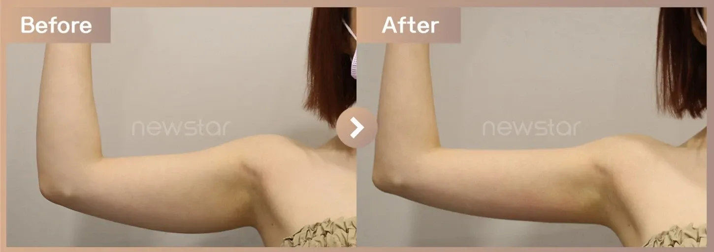 Fat-dissolving injections before-and-after photos at Newstar Clinic
