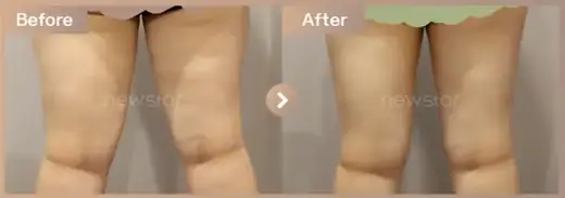 Fat-dissolving injections: before-and-after comparison at Newstar Clinic
