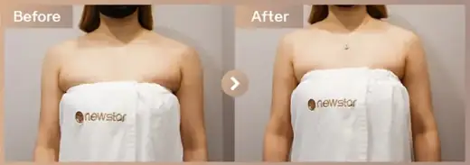 Fat-dissolving injections: before-and-after comparison at Newstar Clinic