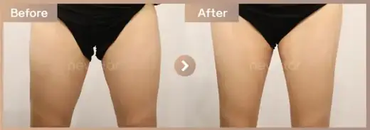 Fat-dissolving injections: before-and-after comparison at Newstar Clinic