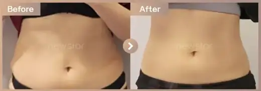 Fat-dissolving injections: before-and-after comparison at Newstar Clinic