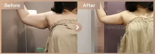 Fat-dissolving injections: before-and-after comparison at Newstar Clinic