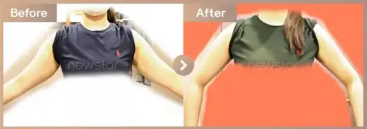 Fat-dissolving injections: before-and-after comparison at Newstar Clinic