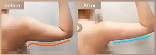 Fat-dissolving injections: before-and-after comparison at Newstar Clinic