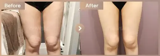Fat-dissolving injections: before-and-after comparison at Newstar Clinic