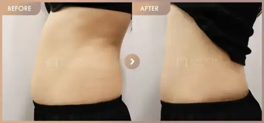 Fat-dissolving injections: before-and-after comparison at Newstar Clinic
