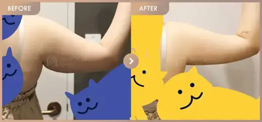 Fat-dissolving injections: before-and-after comparison at Newstar Clinic