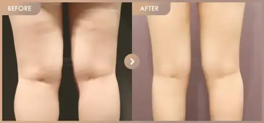 Fat-dissolving injections: before-and-after comparison at Newstar Clinic