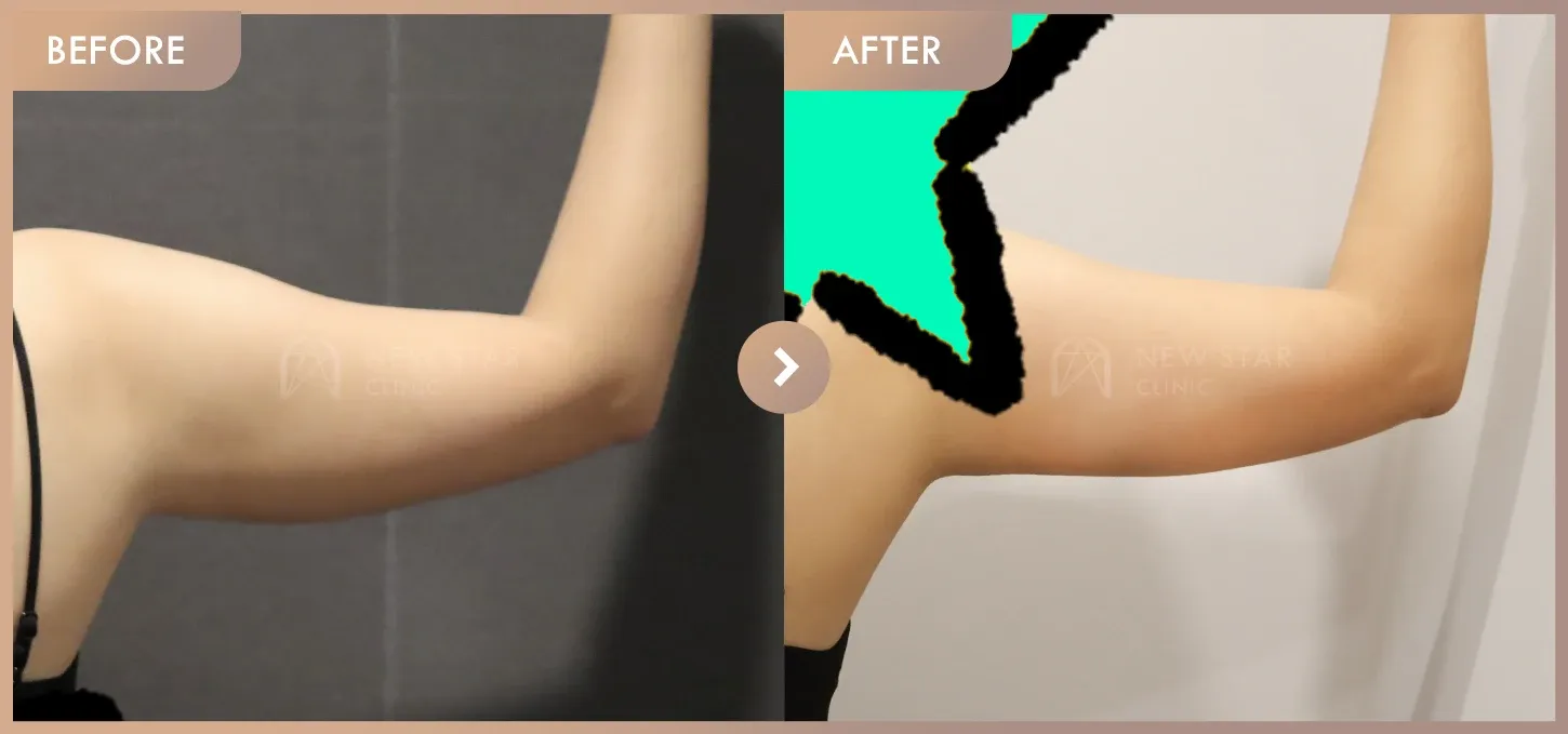 Fat-dissolving injections before-and-after photos at Newstar Clinic