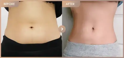 Fat-dissolving injections: before-and-after comparison at Newstar Clinic