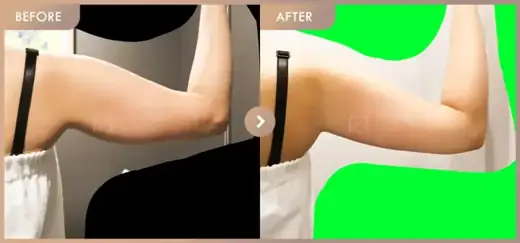 Fat-dissolving injections: before-and-after comparison at Newstar Clinic