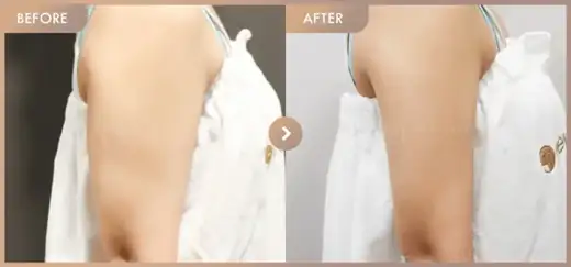 Fat-dissolving injections: before-and-after comparison at Newstar Clinic