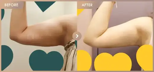 Fat-dissolving injections: before-and-after comparison at Newstar Clinic
