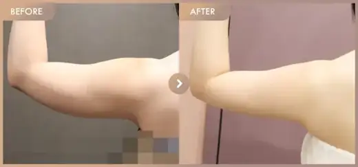 Fat-dissolving injections: before-and-after comparison at Newstar Clinic