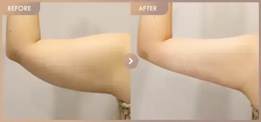 Fat-dissolving injections: before-and-after comparison at Newstar Clinic
