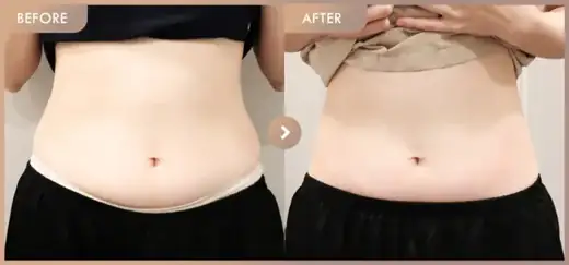 Fat-dissolving injections: before-and-after comparison at Newstar Clinic