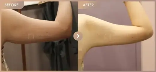 Fat-dissolving injections: before-and-after comparison at Newstar Clinic