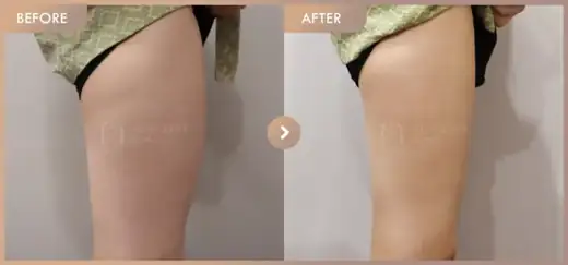 Fat-dissolving injections: before-and-after comparison at Newstar Clinic