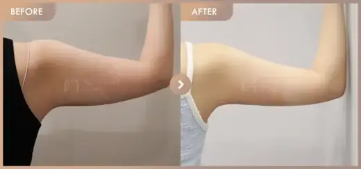 Fat-dissolving injections: before-and-after comparison at Newstar Clinic