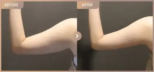 Fat-dissolving injections: before-and-after comparison at Newstar Clinic