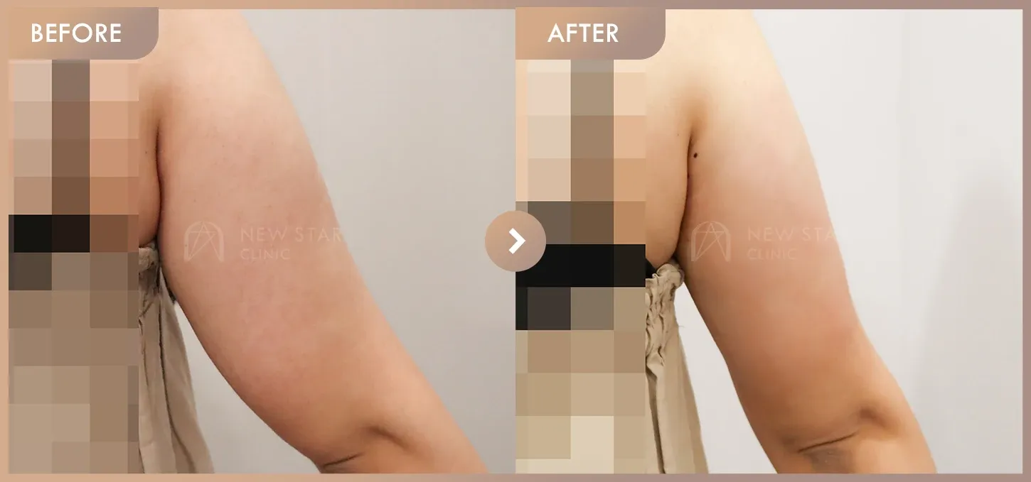 Fat-dissolving injections before-and-after photos at Newstar Clinic