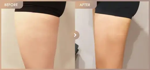 Fat-dissolving injections: before-and-after comparison at Newstar Clinic