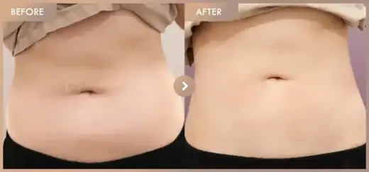 Fat-dissolving injections: before-and-after comparison at Newstar Clinic