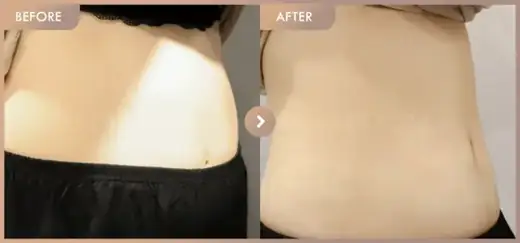 Fat-dissolving injections: before-and-after comparison at Newstar Clinic