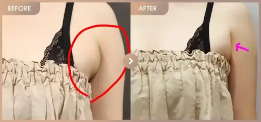 Fat-dissolving injections: before-and-after comparison at Newstar Clinic