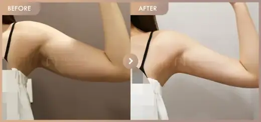 Fat-dissolving injections: before-and-after comparison at Newstar Clinic