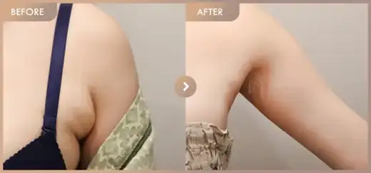 Fat-dissolving injections: before-and-after comparison at Newstar Clinic