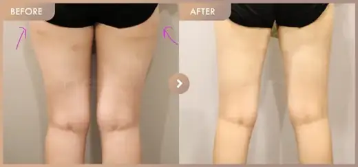Fat-dissolving injections: before-and-after comparison at Newstar Clinic