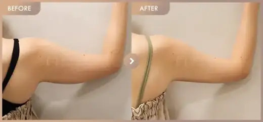 Fat-dissolving injections: before-and-after comparison at Newstar Clinic