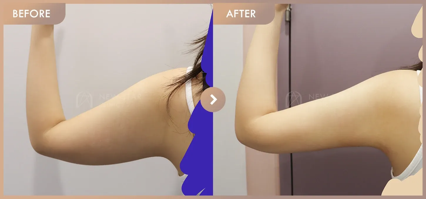 Fat-dissolving injections before-and-after photos at Newstar Clinic