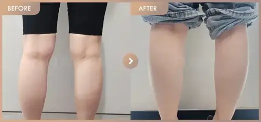 Fat-dissolving injections: before-and-after comparison at Newstar Clinic