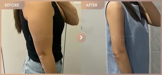 Fat-dissolving injections: before-and-after comparison at Newstar Clinic