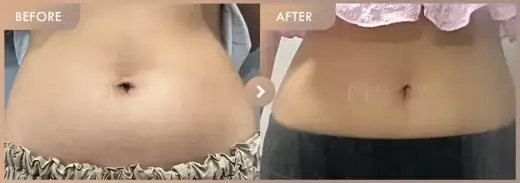 Fat-dissolving injections: before-and-after comparison at Newstar Clinic