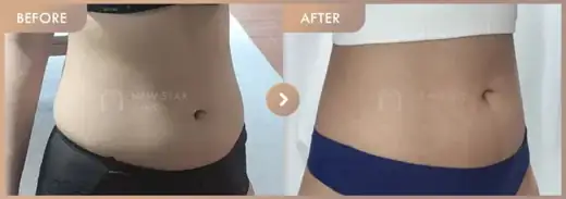 Fat-dissolving injections: before-and-after comparison at Newstar Clinic