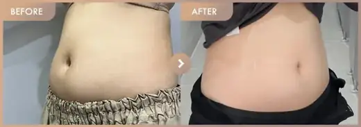Fat-dissolving injections: before-and-after comparison at Newstar Clinic