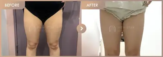 Fat-dissolving injections: before-and-after comparison at Newstar Clinic
