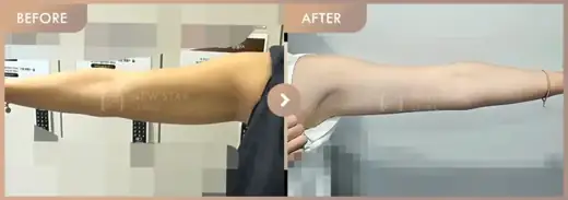 Fat-dissolving injections: before-and-after comparison at Newstar Clinic