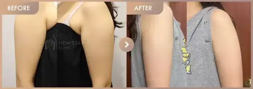 Fat-dissolving injections: before-and-after comparison at Newstar Clinic