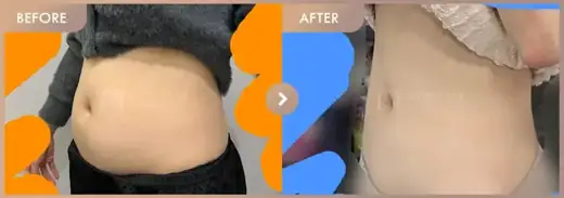 Fat-dissolving injections: before-and-after comparison at Newstar Clinic