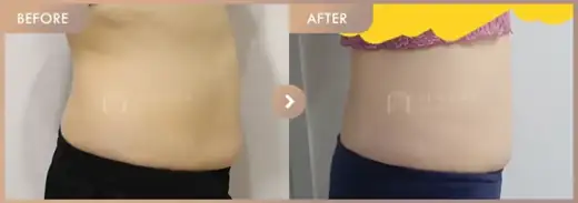 Fat-dissolving injections: before-and-after comparison at Newstar Clinic