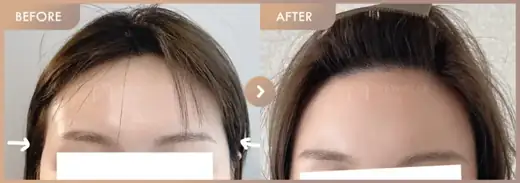 Forehead fillers: before-and-after comparison at Newstar Clinic